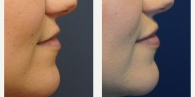 Lip Fillers before and after photo