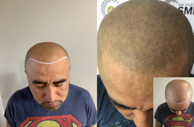 Scalp Micropigmentation before and after photo