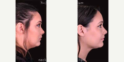 Chin Liposuction before and after photo