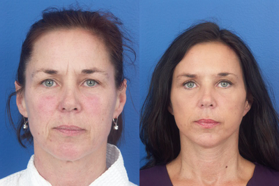 Facelift before and after photo