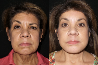 Facelift before and after photo