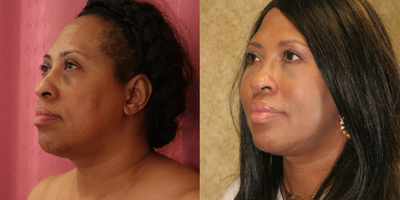 Facial Fat Transfer before and after photo
