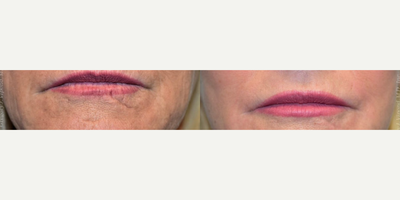 Laser Resurfacing before and after photo