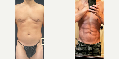 Vaser Liposuction before and after photo
