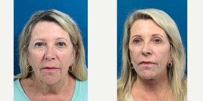 Facelift before and after photo