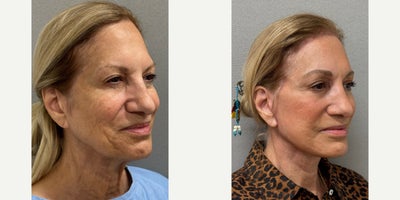 Facelift before and after photo