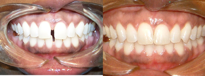 Invisalign before and after photo