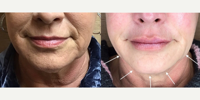 Ultherapy before and after photo