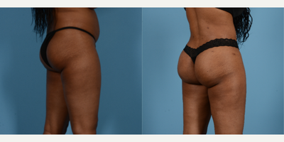 Brazilian Butt Lift before and after photo