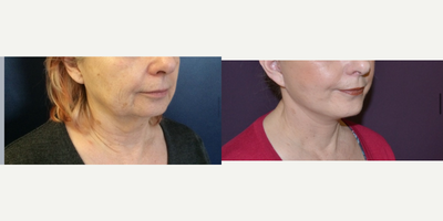 Facelift before and after photo
