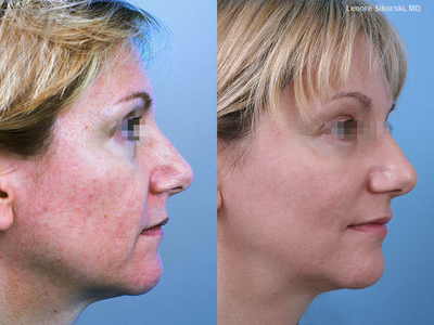 MiXto Laser before and after photo