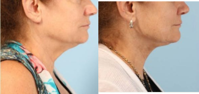 Renuvion before and after photo