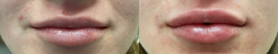 Restylane Defyne before and after photo