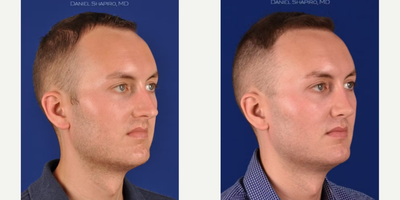 Rhinoplasty before and after photo
