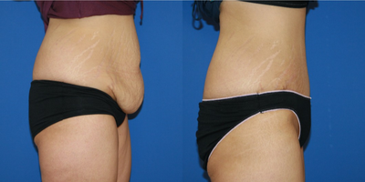Tummy Tuck before and after photo