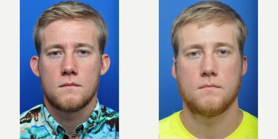 Ear Surgery before and after photo