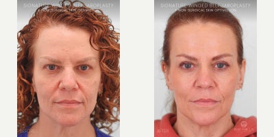 Eyelid Surgery before and after photo