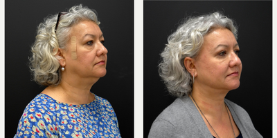 Facelift before and after photo