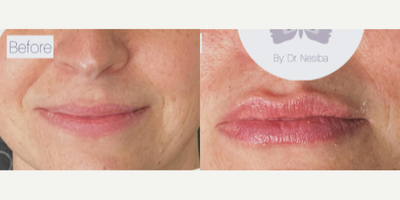Lip Fillers before and after photo