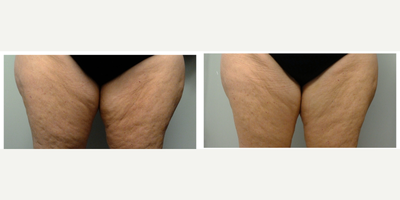 Vanquish before and after photo