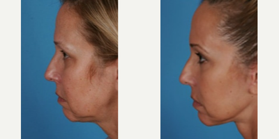 Facelift before and after photo