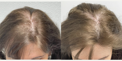 Hair Loss Treatment before and after photo