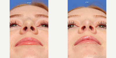 Rhinoplasty before and after photo