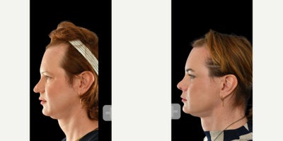 Rhinoplasty before and after photo