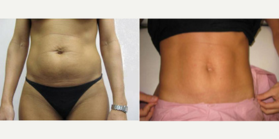 Tummy Tuck before and after photo