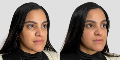 Belotero before and after photo