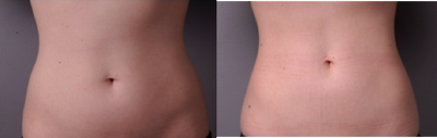 CoolSculpting before and after photo