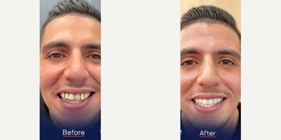 Dental Crown before and after photo