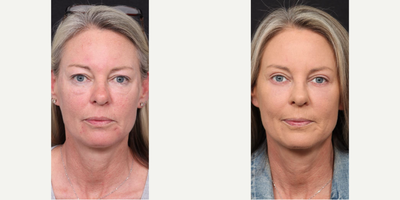 Eyelid Surgery before and after photo