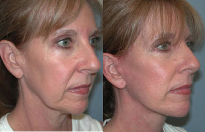 Facelift before and after photo