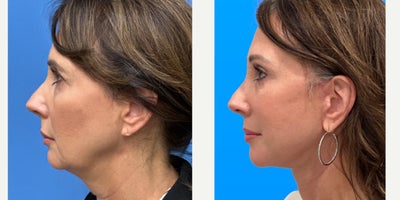 Facelift before and after photo