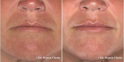 Lip Fillers before and after photo