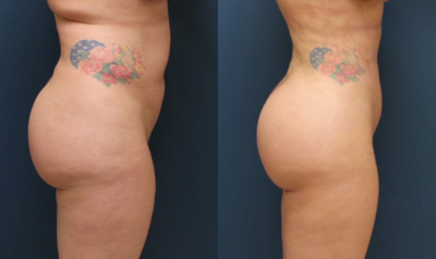 Liposuction before and after photo
