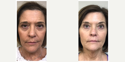 Liquid Facelift before and after photo