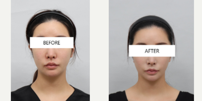 Mini Facelift before and after photo