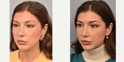 Rhinoplasty before and after photo