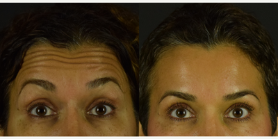 Botox before and after photo