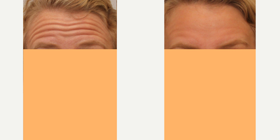 Botox before and after photo