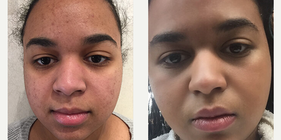 Chemical Peel before and after photo