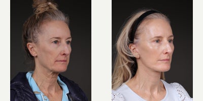 Neck Lift before and after photo