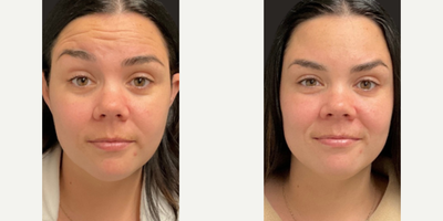 Botox before and after photo