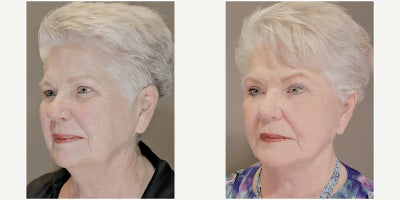 Lower Facelift before and after photo