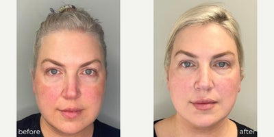 Chemical Peel before and after photo