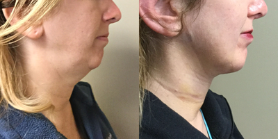 Chin Liposuction before and after photo