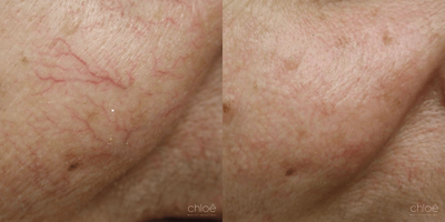 Laser Resurfacing before and after photo