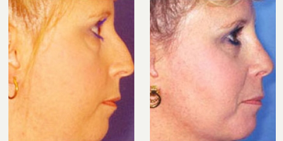 Rhinoplasty before and after photo